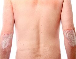 Psoriasis: qué es, sus complicaciones para la salud de la piel y tratamiento
