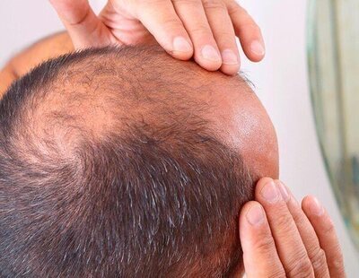 La vacuna contra la alopecia, cada vez más cerca: ¿adiós a los trasplantes capilares?