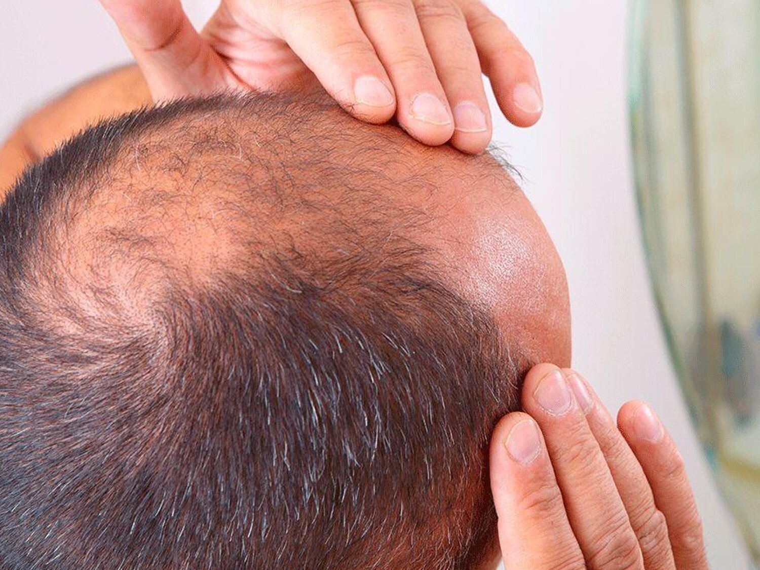 La vacuna contra la alopecia, cada vez más cerca: ¿adiós a los trasplantes capilares?