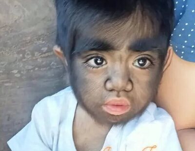 El insólito caso de Jaren, el niño más peludo del mundo: su madre cree que está "maldito"