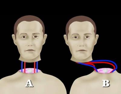 El primer transplante de cabeza se realizará en 2017 en medio de la polémica