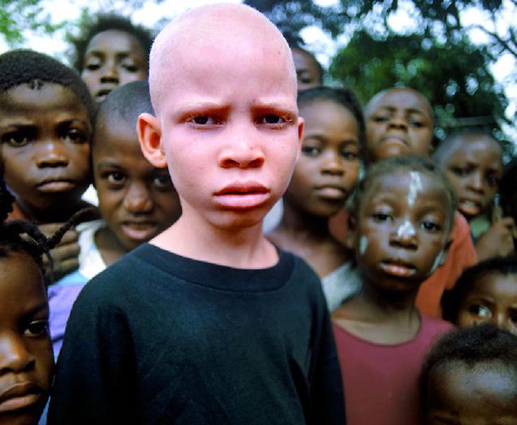 La persecución a los albinos en África no cesa