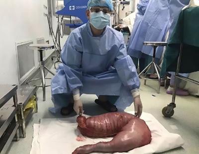 Extraen 13 kilos de intestinos a un hombre que padecía estreñimiento desde hacía varios años