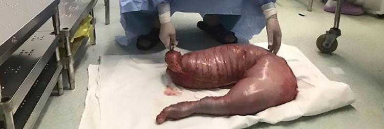 Resultado de imagen para le extirparon 13 kilos de materia fecal por estreÃ±imiento extremo