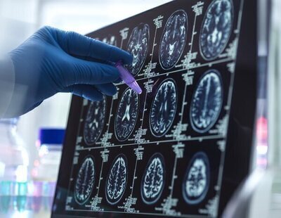 Una mujer denuncia a la sanidad andaluza por confundir un tumor cerebral con estrés