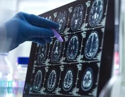 Una mujer denuncia a la sanidad andaluza por confundir un tumor cerebral con estrés