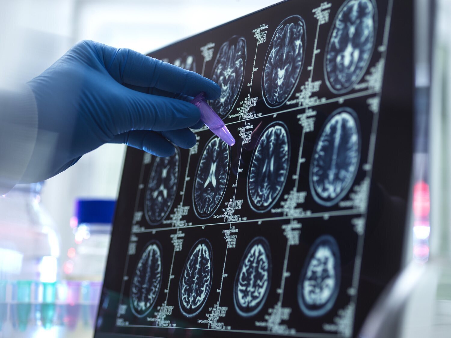 Una mujer denuncia a la sanidad andaluza por confundir un tumor cerebral con estrés