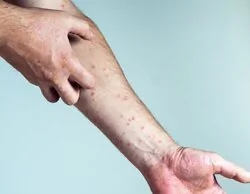 Alerta por viruela del mono en Madrid: primer caso con la variante más agresiva