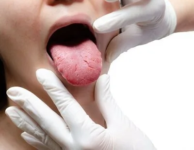 Qué significa una mancha blanca en la lengua: la alerta de un médico