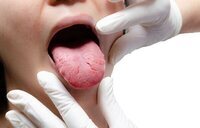 Qué significa una mancha blanca en la lengua: la alerta de un médico