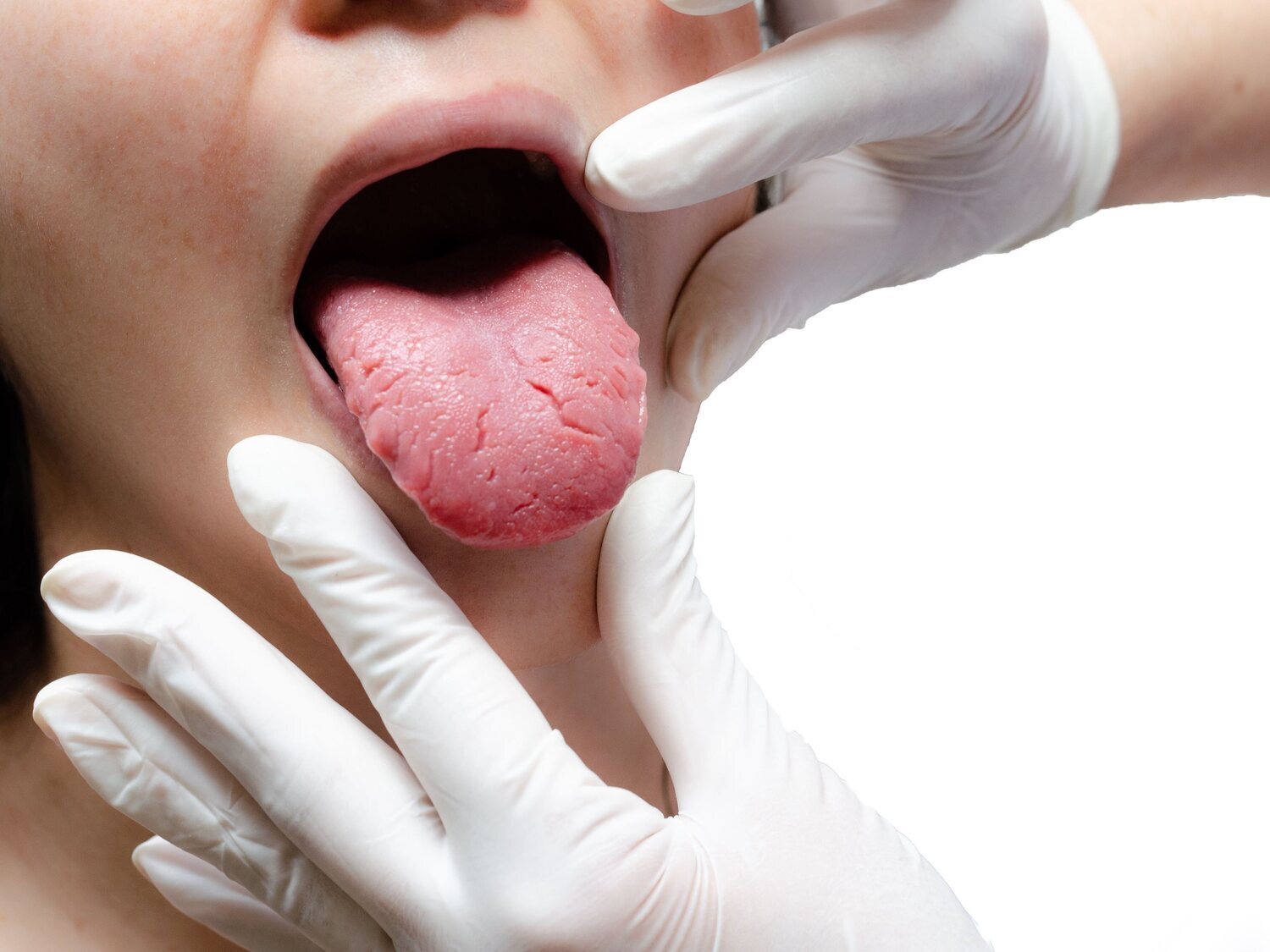 Qué significa una mancha blanca en la lengua: la alerta de un médico