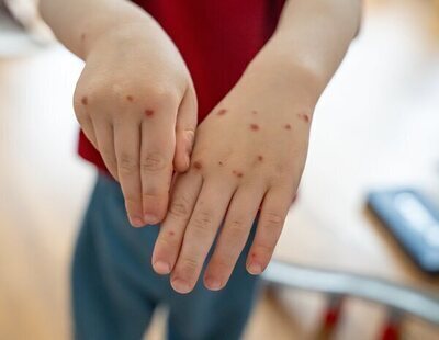 La OMS retira a España de los países libres de sarampión: llama a reforzar medidas