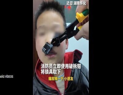 Rescate insólito en China: cortan un candado atrapado en la nariz de un niño