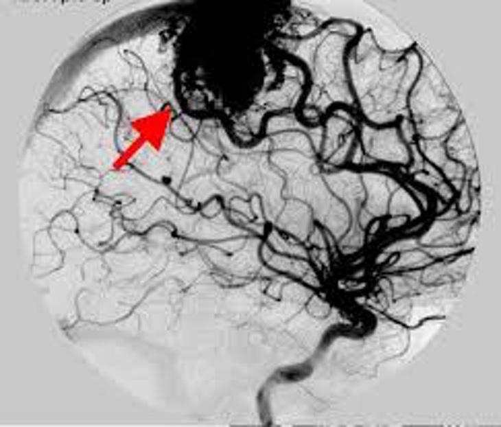 Malformación Arteriovenosa Rayos X