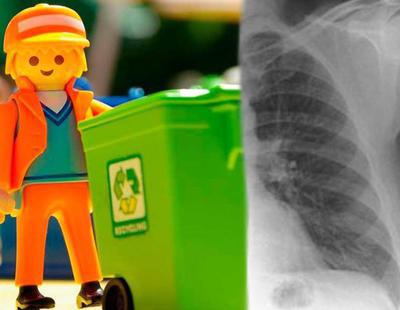 No tenía cáncer: llevaba 40 años con un Playmobil incrustado en el pulmón