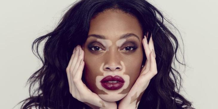 Winnie Harlow