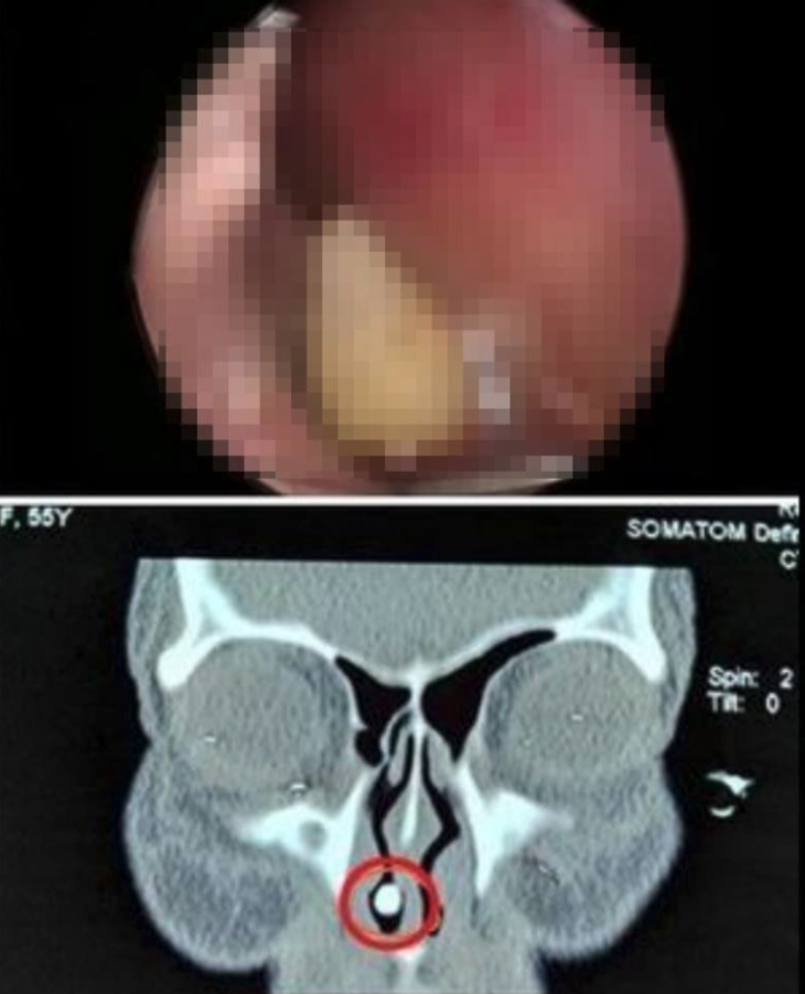 Tras hacerle la radiografía, identificaron un objeto de masa densa en su fosa nasal derecha