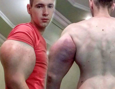 Un fisioculturista ruso se inyecta litros de aceite en los brazos para ser como Popeye