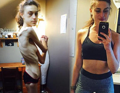 Una chica con anorexia superó su enfermedad gracias a Instagram