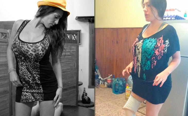 Mariela Ayala, antes y después de la operación