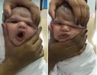 Despedidas tres enfermeras por estrujar la cara de bebés recién nacidos