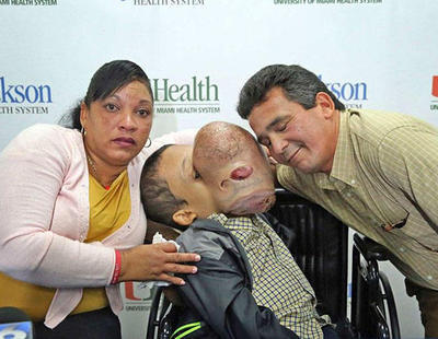 Muere el niño cubano al que le extrajeron un tumor facial de 4,5 kg