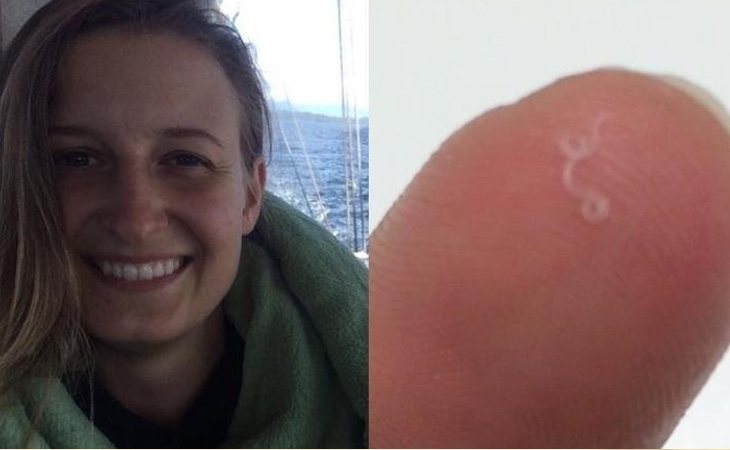 La mujer encontró hasta 14 gusanos en el interior de su ojo