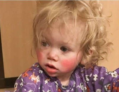 La niña que sufre alergia a sus propias lágrimas: le provocan quemaduras de tercer grado