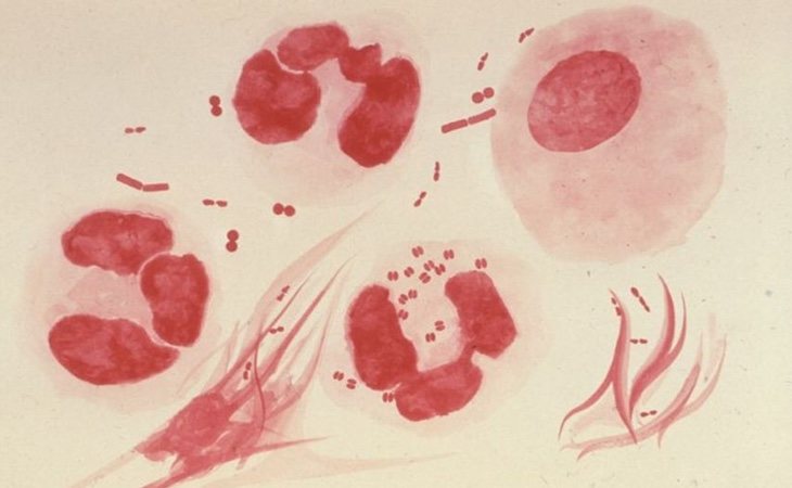 La gonorrea es causada por la bacteria Neisseria gonorrhoeae