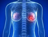 Consiguen eliminar toda la metástasis de una paciente con cáncer de mama en Estados Unidos