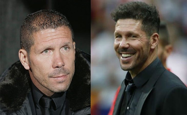 El entrenador del Atlético Diego Simeone se sometió al injerto de pelo