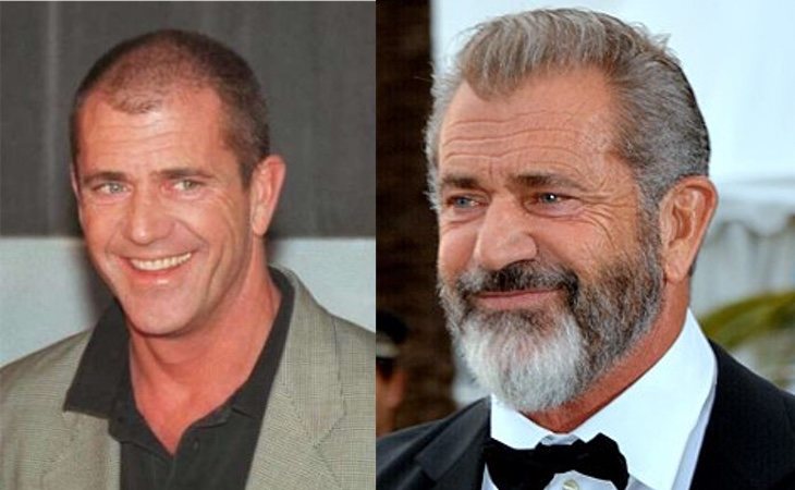 Mel Gibson se sometió a un injerto de pelo