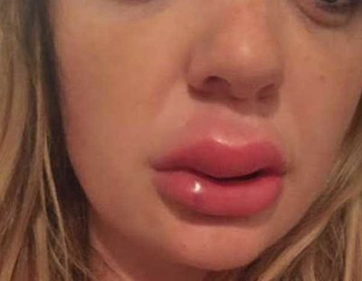Un relleno de labios low cost deja a una chica una tremenda infección y supurando pus