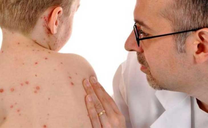 La extremada importancia de la vacunación contra el sarampión