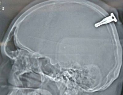 El hombre que sobrevivió con una llave de motocicleta incrustada en el cerebro