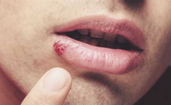 La donovanosis se puede dar también en labios, encías, garganta o mejillas