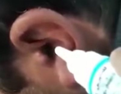 El escalofriante vídeo en que un ciempiés vivo sale del oído de un paciente por su cuenta