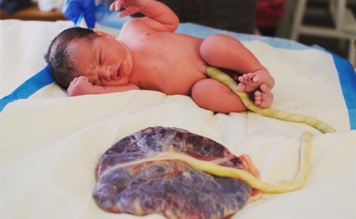 La placenta y el cordón todavía conectados