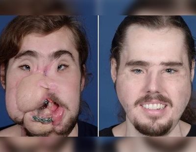La historia del joven que ha recibido el transplante de cara más avanzado de la historia