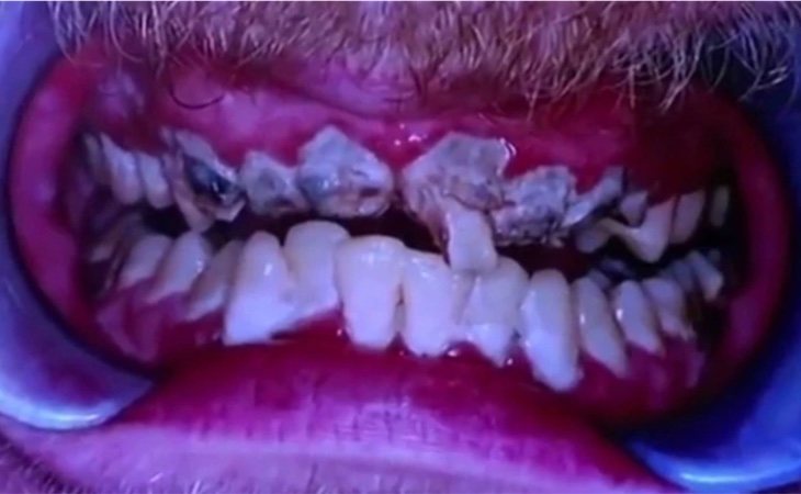 La maltrecha dentadura de Jay antes del tratamiento