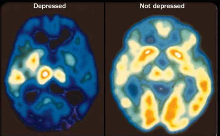 Cerebro depresivo y sano