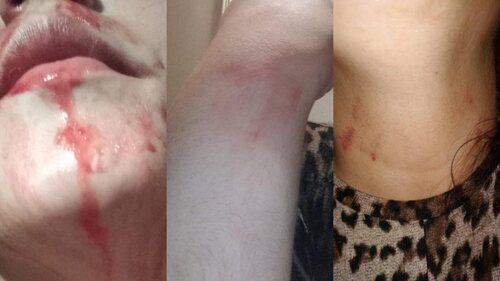 Heridas sufridas por la joven trans en la agresión