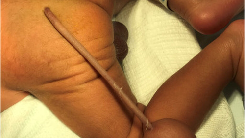 Un bebé nace con una cola de 12 centímetros