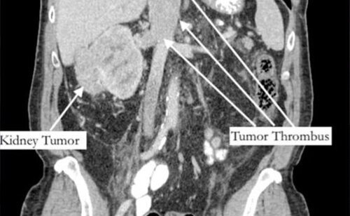 El TAC de Bernstein revela su tumor renal y su trombo tumoral
