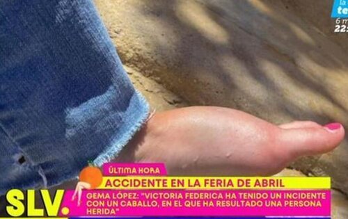 Pie de la joven tras ser pisada por el caballo de Victoria Federica en la Feria de Abril