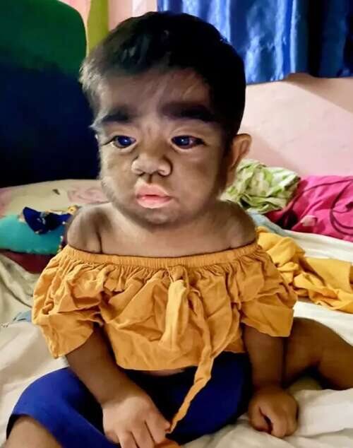 Jaren Gamongan, el pequeño que sufre de hipertricosis