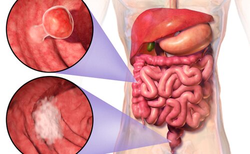 Cáncer de colorrectal