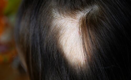 Los medicamentos señalados son utilizados en el tratamiento de la alopecia