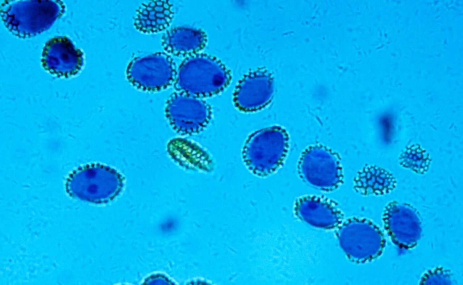 Se disparan los contagios de esquistosomiasis en España: síntomas y ...
