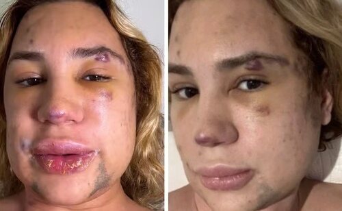 Adair Mendez Dutra Junior reveló las graves secuelas de su cirugía antes de su fallecimiento